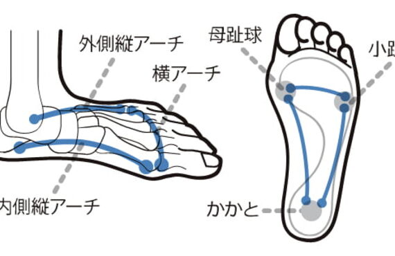 カスタムインソール外反母趾